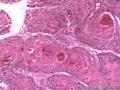 食管粘膜，鳞癌图8