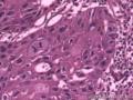 食管粘膜，鳞癌图18