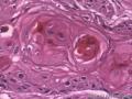食管粘膜，鳞癌图9