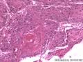 食管粘膜，鳞癌图7