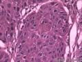 食管粘膜，鳞癌图10