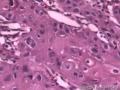 食管粘膜，鳞癌图3