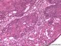 食管粘膜，鳞癌图19
