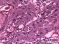 食管粘膜，鳞癌图17