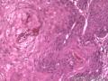食管粘膜，鳞癌图13