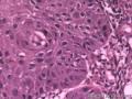 食管粘膜，鳞癌图11