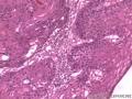 食管粘膜，鳞癌图14