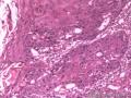 食管粘膜，鳞癌图15