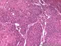 食管粘膜，鳞癌图12