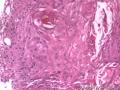 食管粘膜，鳞癌图16