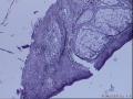 外阴赘生物活检。图18