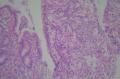 胃镜：炎性病变。显微镜下像不像印戒细胞癌？图4