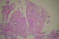 胃镜：炎性病变。显微镜下像不像印戒细胞癌？图2