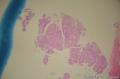 胃镜：炎性病变。显微镜下像不像印戒细胞癌？图1