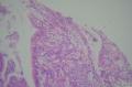 胃镜：炎性病变。显微镜下像不像印戒细胞癌？图3