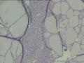 左甲状腺内密集的空泡细胞，有问题吗？图24