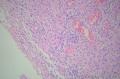 请教：够胶质母细胞瘤不？（血管丰富、坏死、梭形细胞）图15