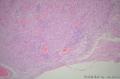 请教：够胶质母细胞瘤不？（血管丰富、坏死、梭形细胞）图13