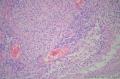 请教：够胶质母细胞瘤不？（血管丰富、坏死、梭形细胞）图14
