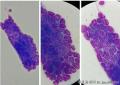 乳腺肿物穿刺， 是恶性还是良性？图18