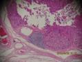 卵巢畸胎瘤请教诊断（请见21-26楼美国cqzhao教授的意见和点评）图20