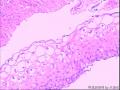 40岁宫颈液基加活检590图20