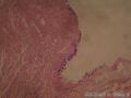 结肠肠壁带蒂肿物图12