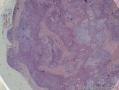 颌下多形性腺瘤，包膜侵犯图1