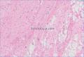 食管粘膜下肿块--上海市骨与软组织读片2013（1-5）由复旦大学中山医院提供图14