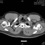 食管粘膜下肿块--上海市骨与软组织读片2013（1-5）由复旦大学中山医院提供图1