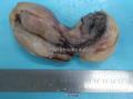食管粘膜下肿块--上海市骨与软组织读片2013（1-5）由复旦大学中山医院提供图2