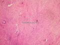 后腹膜肿块-上海市骨与软组织读片2013(10)复旦大学华东医院供图3