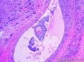 右卵巢绒毛膜癌图5