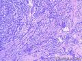 右卵巢绒毛膜癌图14