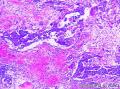 右卵巢绒毛膜癌图1