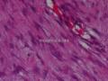 后腹膜肿块-上海市骨与软组织读片2013(10)复旦大学华东医院供图6
