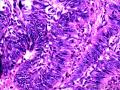 乳头状鳞状细胞癌图18