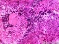 乳头状鳞状细胞癌图3