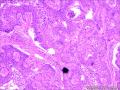 乳头状鳞状细胞癌图9