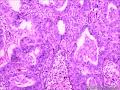 乳头状鳞状细胞癌图7