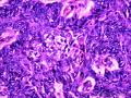 乳头状鳞状细胞癌图21