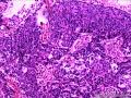 乳头状鳞状细胞癌图1
