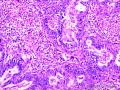 乳头状鳞状细胞癌图15