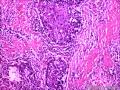 乳头状鳞状细胞癌图13