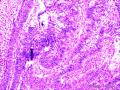 乳头状鳞状细胞癌图17