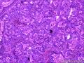 乳头状鳞状细胞癌图10