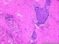 乳头状鳞状细胞癌图5