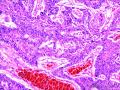 乳头状鳞状细胞癌图16