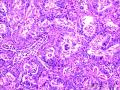乳头状鳞状细胞癌图14