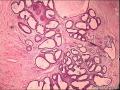 乳腺纤维腺瘤间质水肿还是叶状肿瘤呢图5